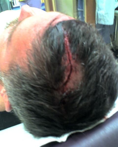 stapled head wound